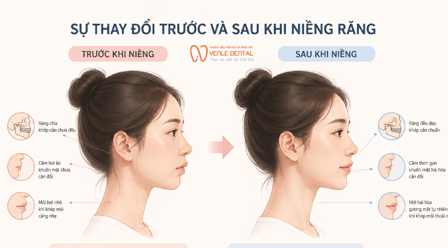 niềng răng làm thay đổi khuôn mặt như thế nào